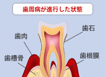 歯周病が進行した状態