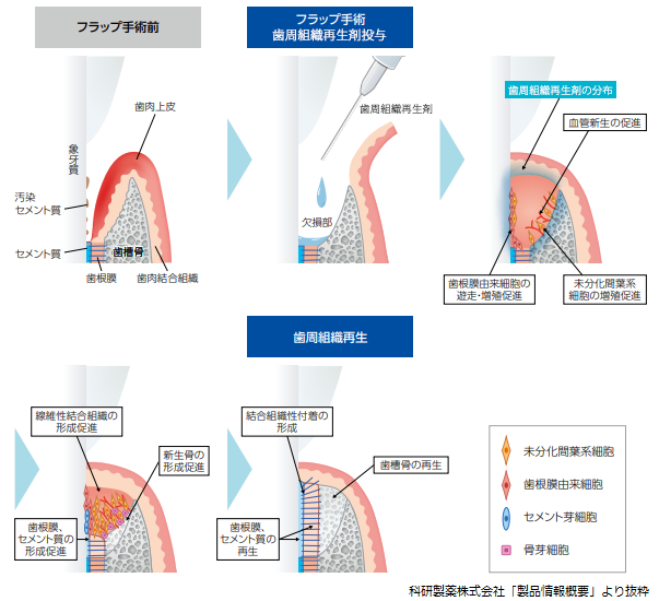 歯周組織再生フロー